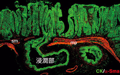 マウスの腸にできた腫瘍細胞（緑色）が悪性化し、底部に向かって浸潤している様子