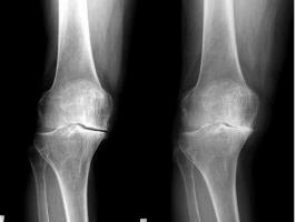 上下の膝の骨の間にまだ軟骨が残っている（左）が、かなり症状が進行し、軟骨部分がほとんどなくなってしまっている（右）