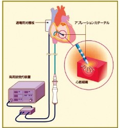 カテーテルアプレーション