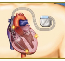 心臓再同期療法（ＣＲＴ）